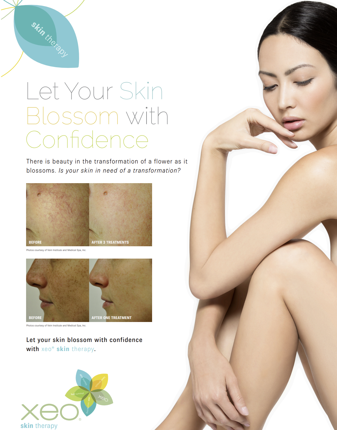 Why IPL Treatment with Cutera XEO+ Stands Out in the Market