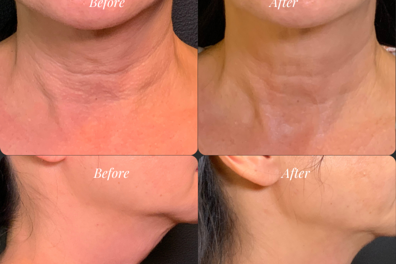 Why Choose Radiesse Over Traditional Fillers