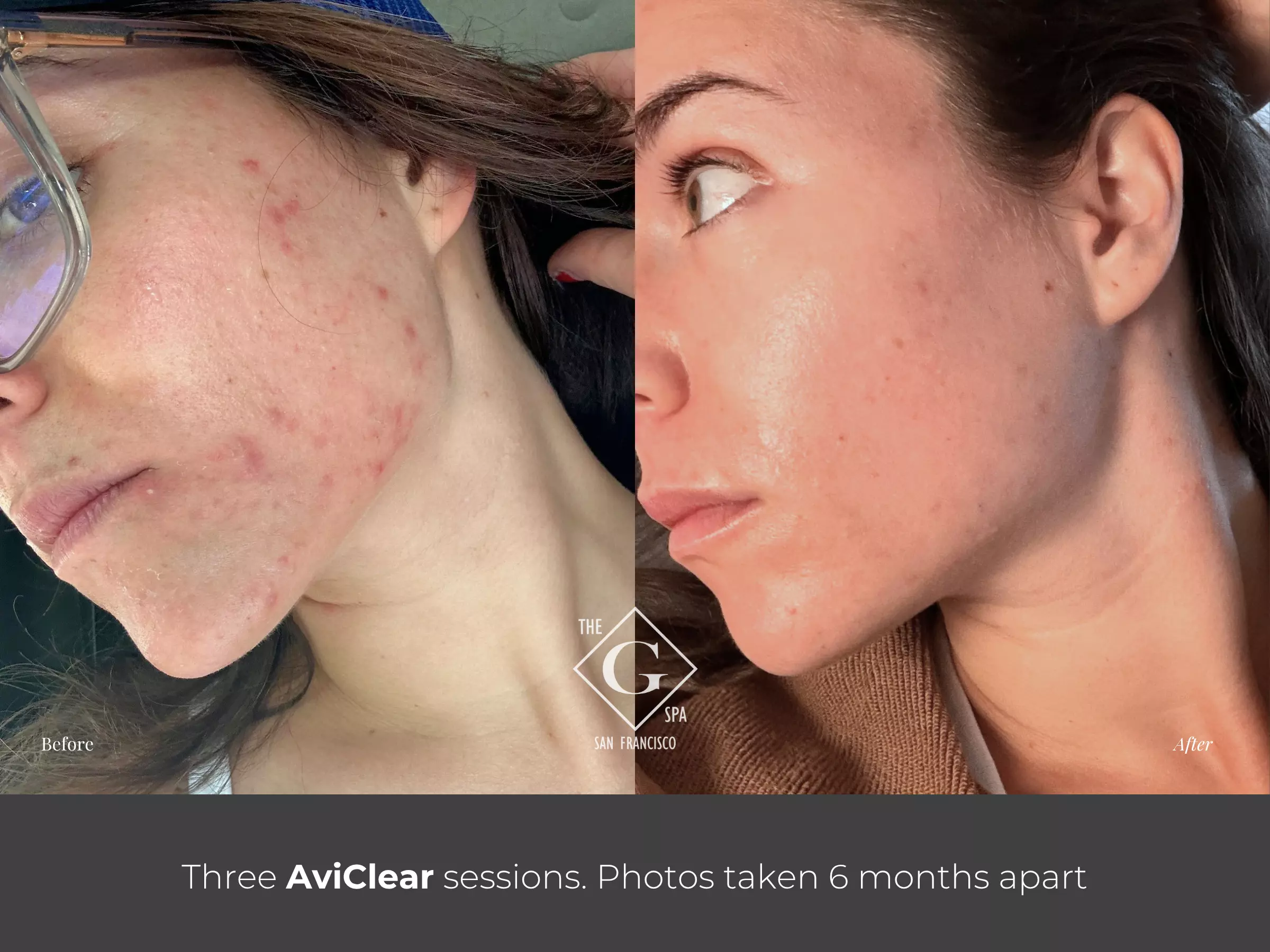 AviClear before and after acne treatment result at The G Spa San Francisco