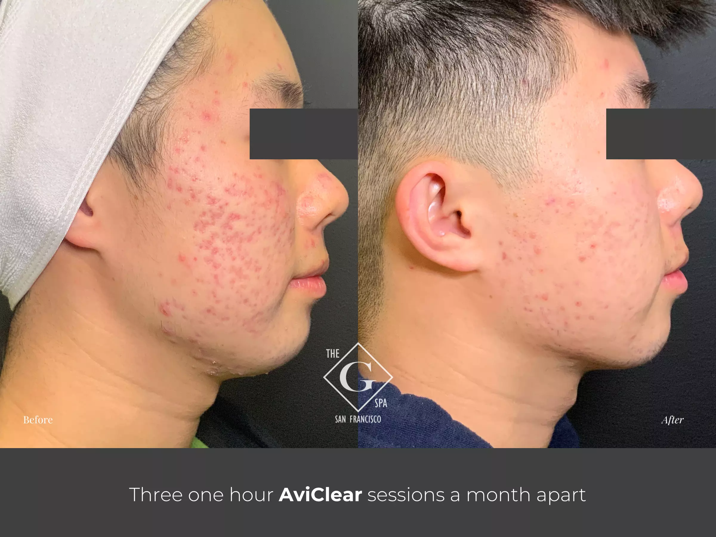 AviClear before and after acne treatment result at The G Spa