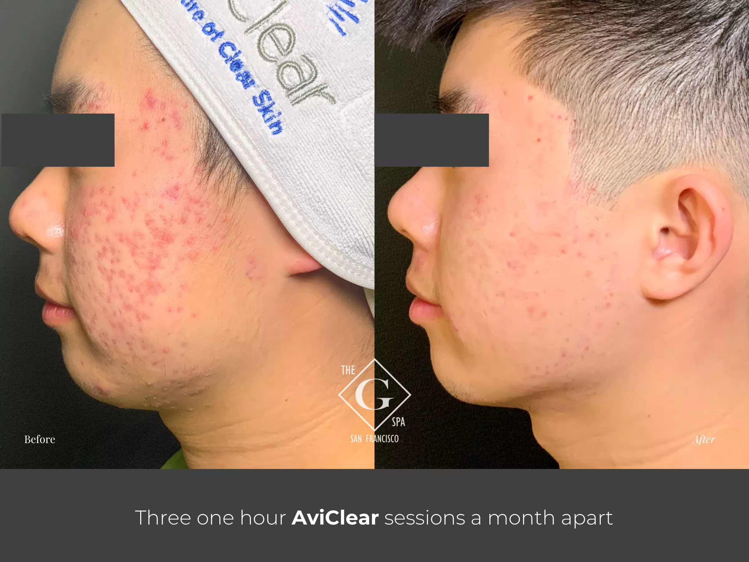 AviClear before and after acne treatment result after three sessions