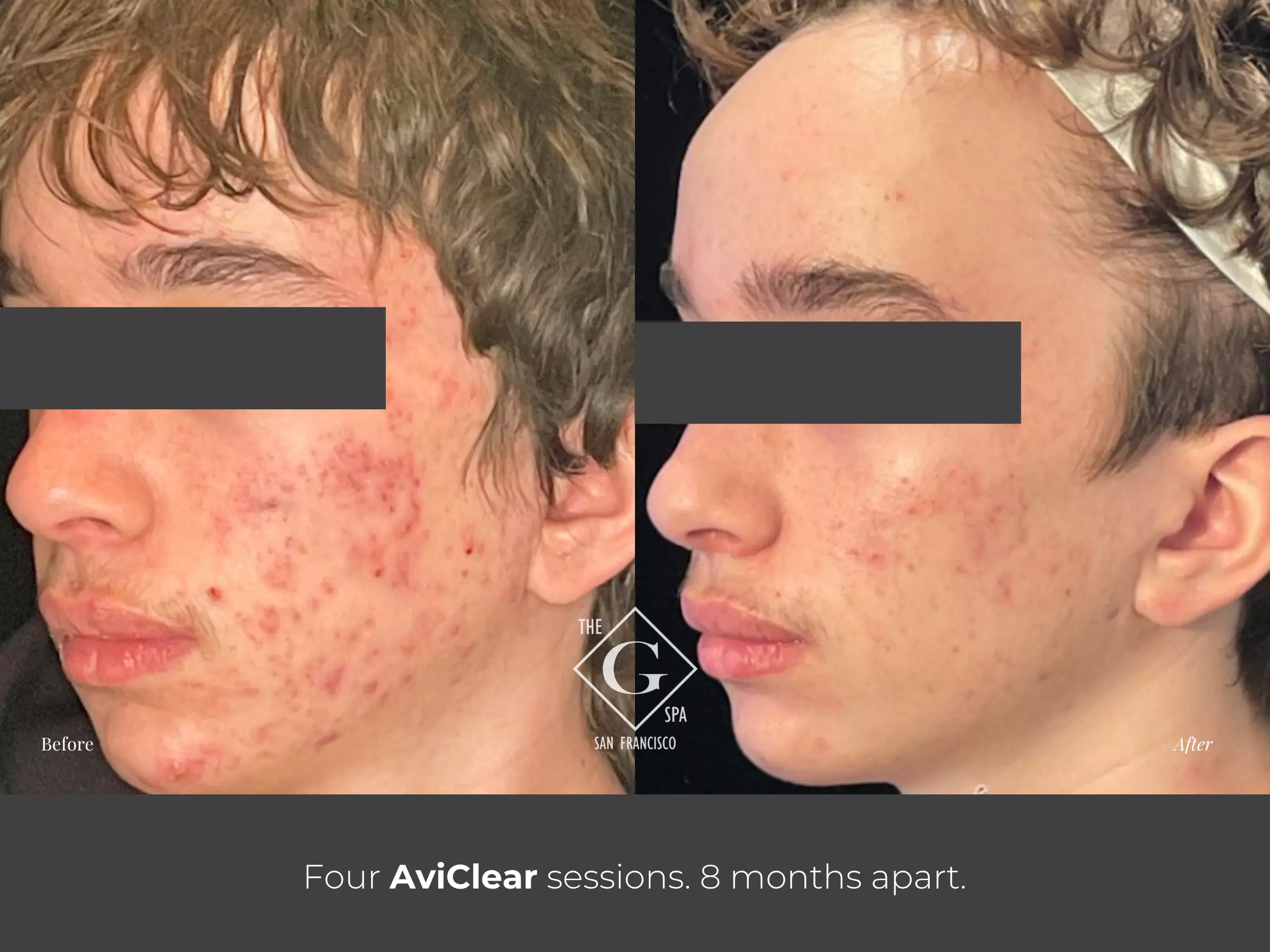 AviClear before and after acne treatment result after four sessions